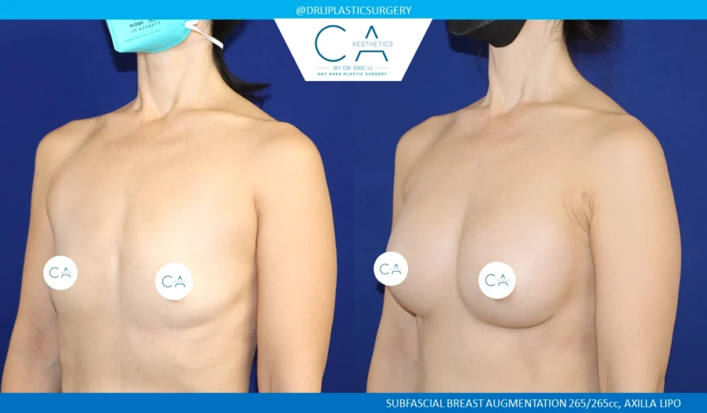 Breast Augmentation case #8732
