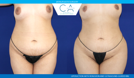 360 Liposuction (Torso) case #8654