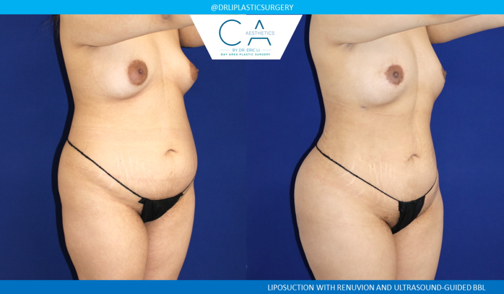 360 Liposuction (Torso) case #8654