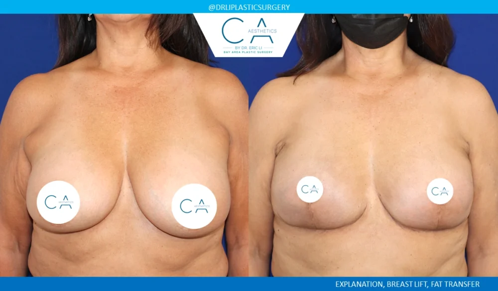 Breast Implant Removal case #8827