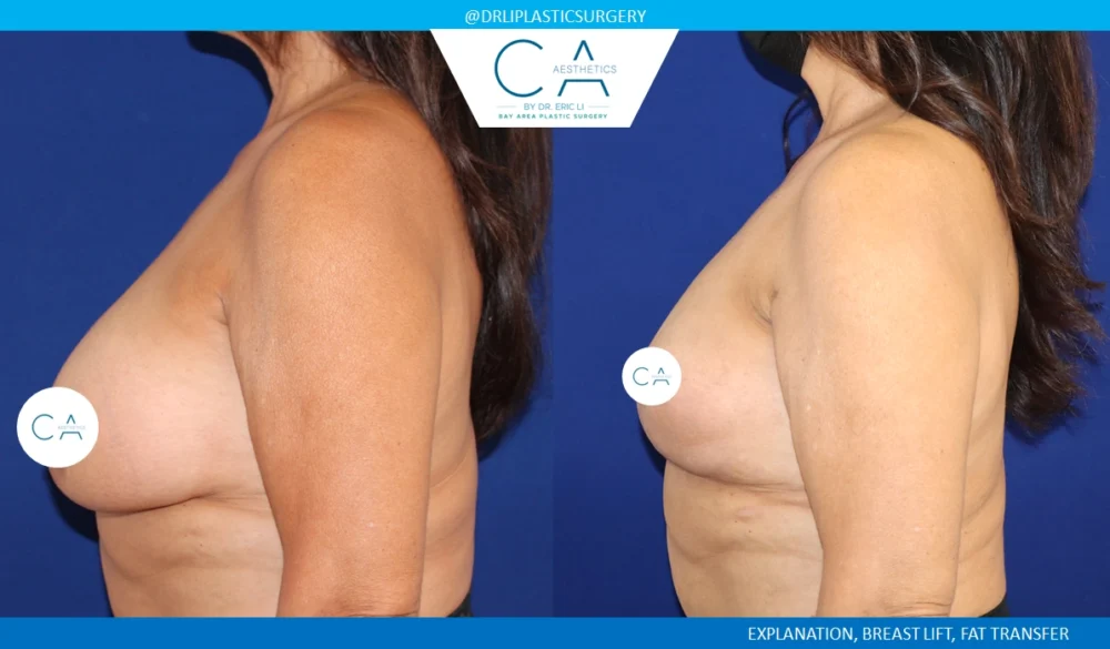 Breast Implant Removal case #8827