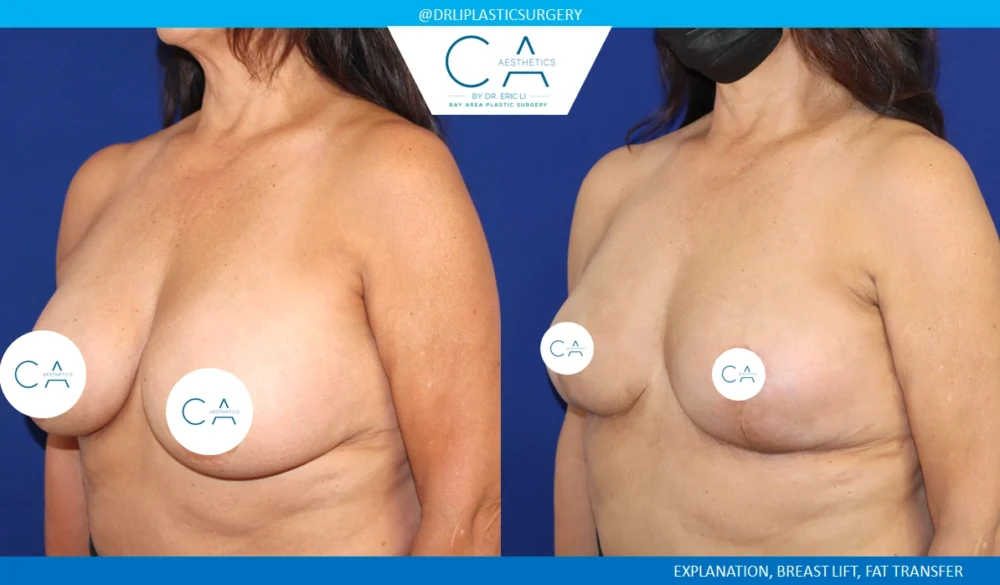 Breast Implant Removal case #8827