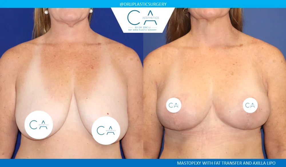 Fat Transfer Breast Augmentation case #8697