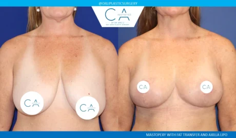 Fat Transfer Breast Augmentation case #8697
