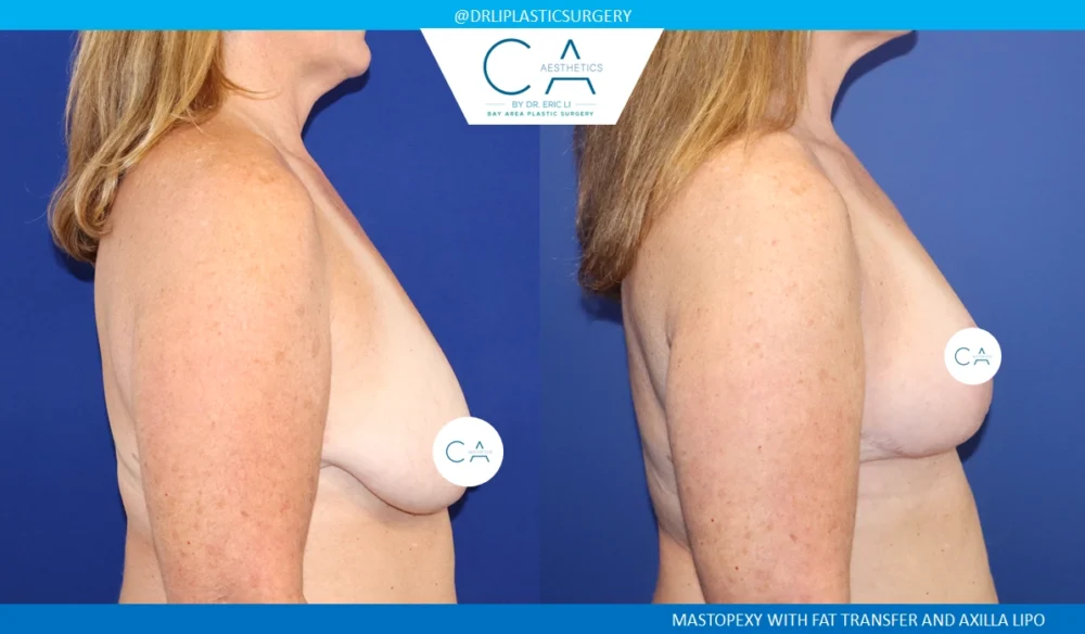 Fat Transfer Breast Augmentation case #8697