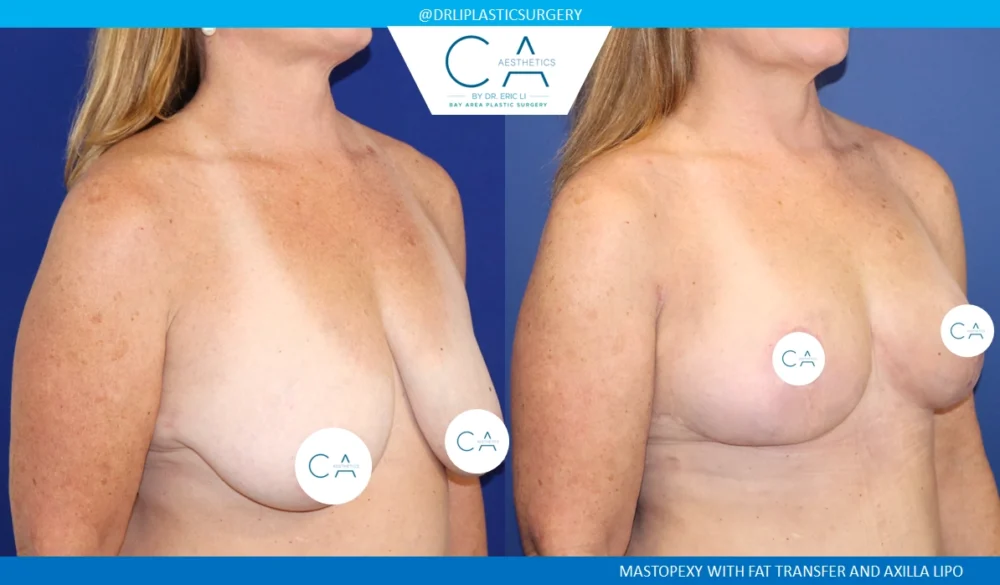 Fat Transfer Breast Augmentation case #8697