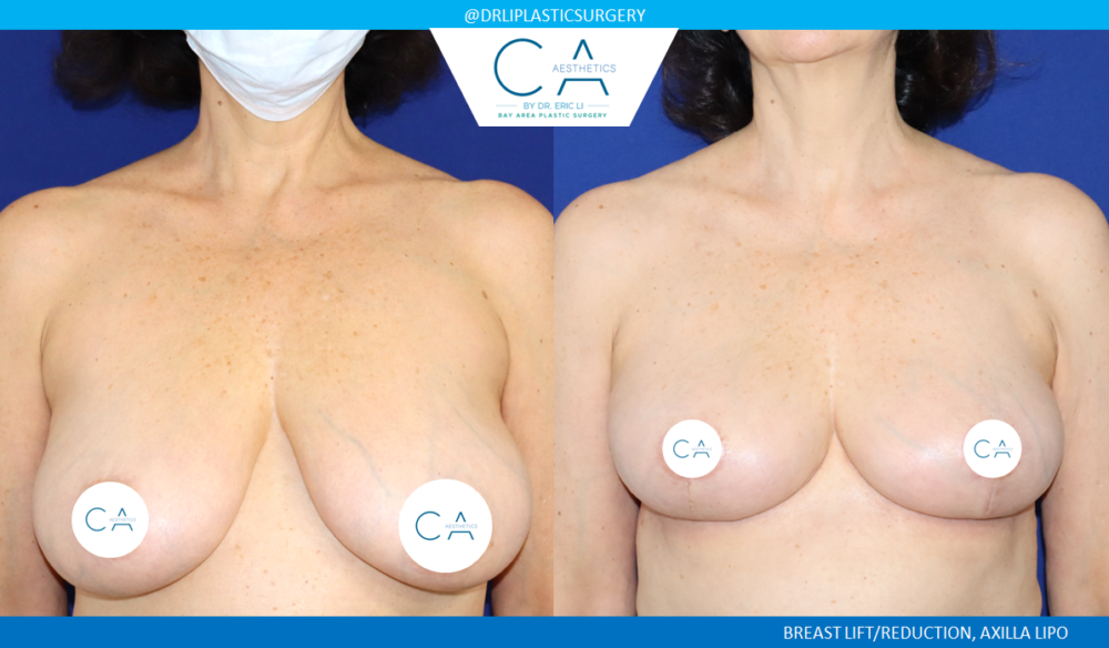 Breast Reduction case #8803