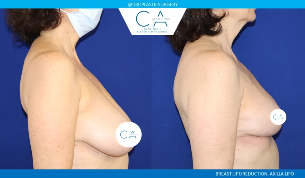 Breast Reduction case #8803