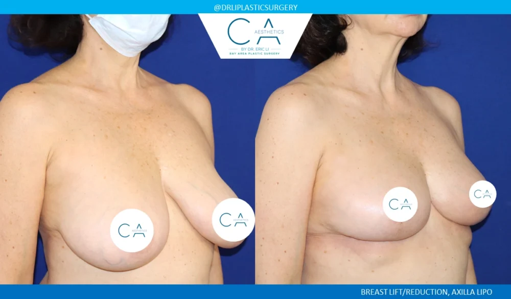 Breast Reduction case #8803