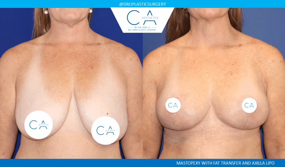 Breast Lift case #8854