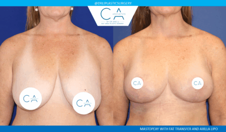Breast Lift case #8854