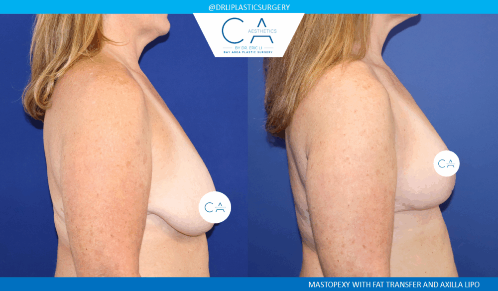 Breast Lift case #8854