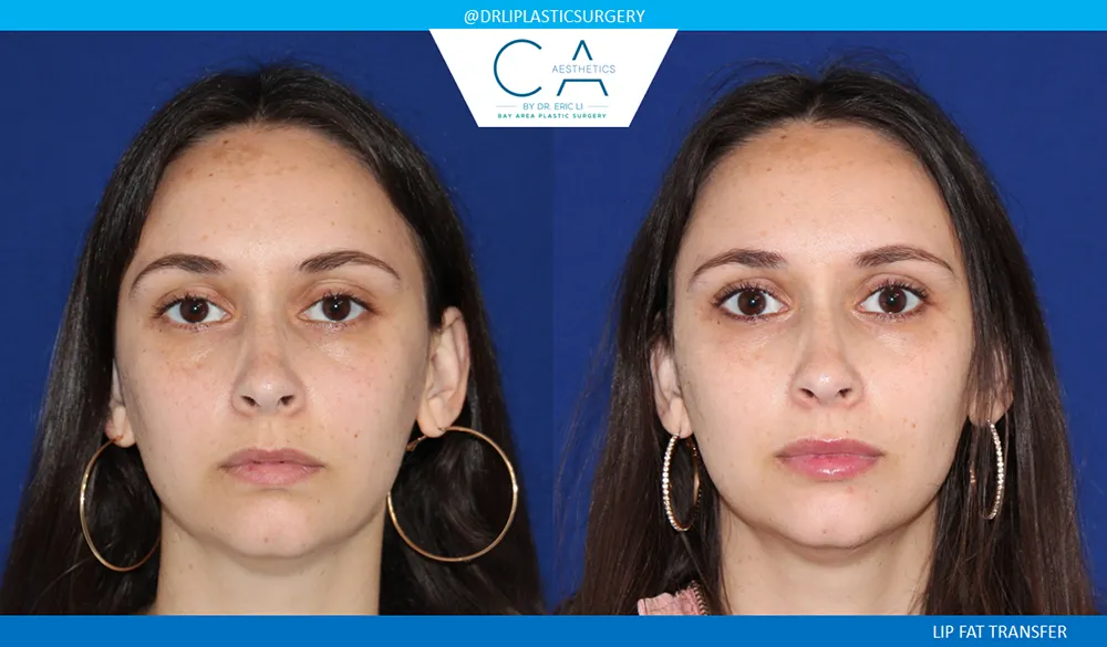 Facial Implants and Fat Transfer case #9076