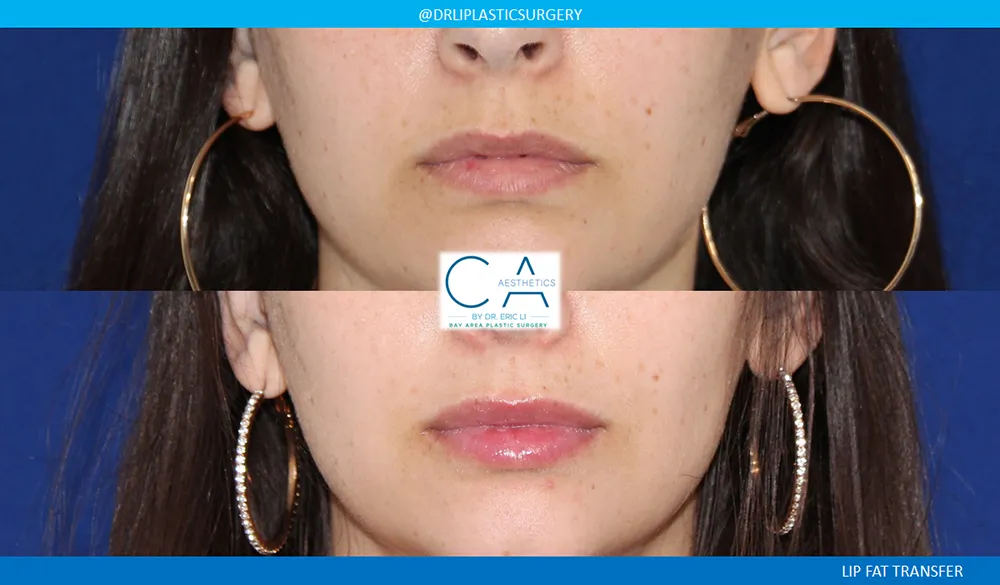 Facial Implants and Fat Transfer case #9076