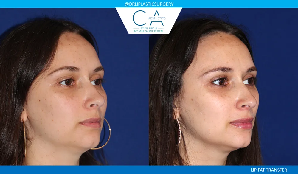 Facial Implants and Fat Transfer case #9076