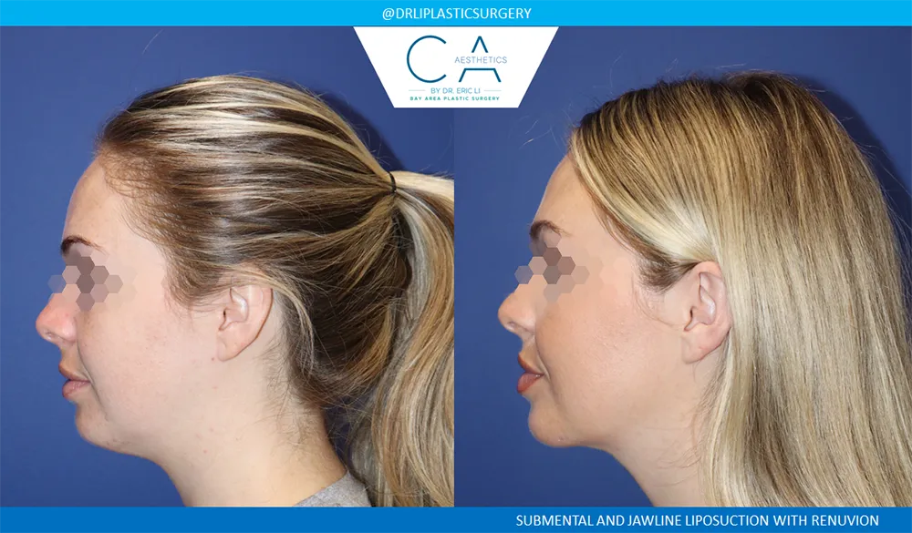 Face & Neck Liposuction case #9065
