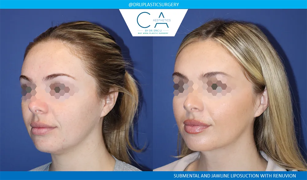 Face & Neck Liposuction case #9065