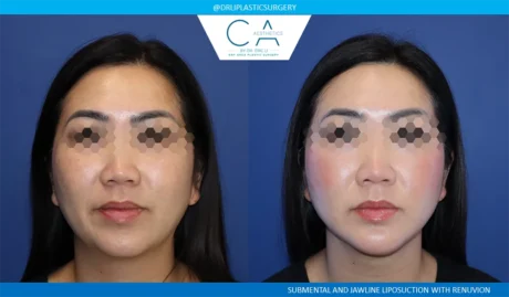 Face & Neck Liposuction case #9068