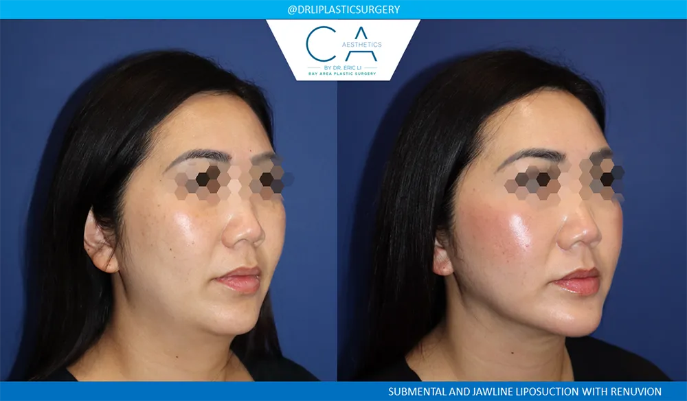 Face & Neck Liposuction case #9068