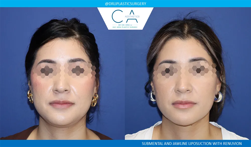Face & Neck Liposuction case #9072