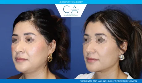 Face & Neck Liposuction case #9072