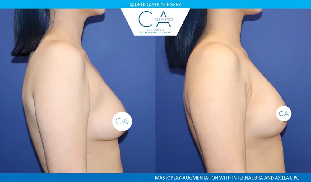 Breast Lift case #9124