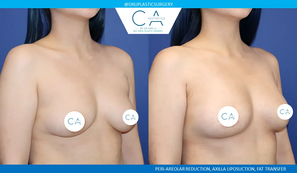 Breast Lift case #9124