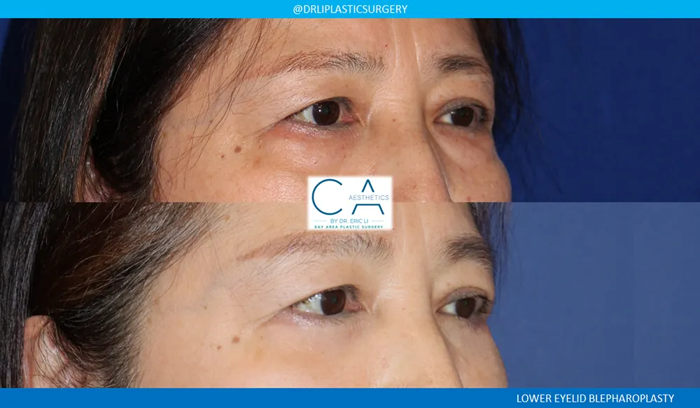 Lower Blepharoplasty (Eyelid Surgery) case #9112