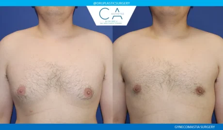 Gynecomastia case #9082