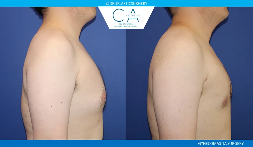 Gynecomastia case #9082