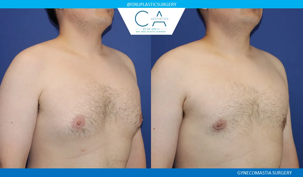 Gynecomastia case #9082