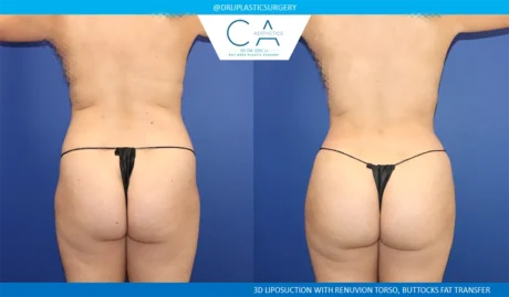 Brazilian Butt Lift case #8979
