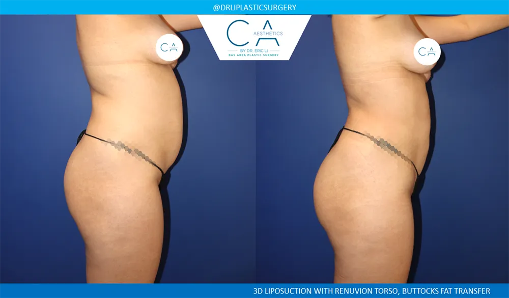 Brazilian Butt Lift case #8979