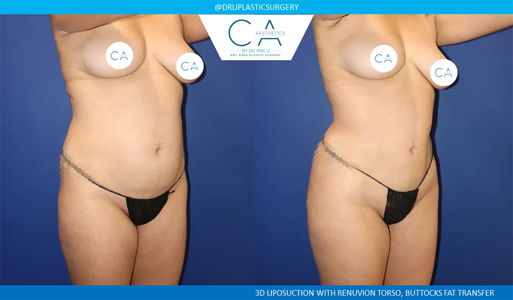 Brazilian Butt Lift case #8979