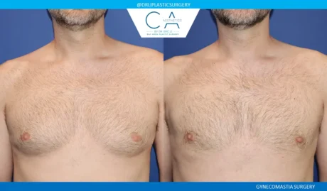 Gynecomastia case #9086