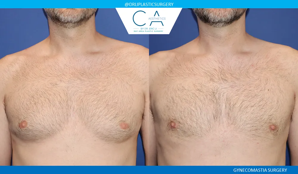 Gynecomastia case #9086