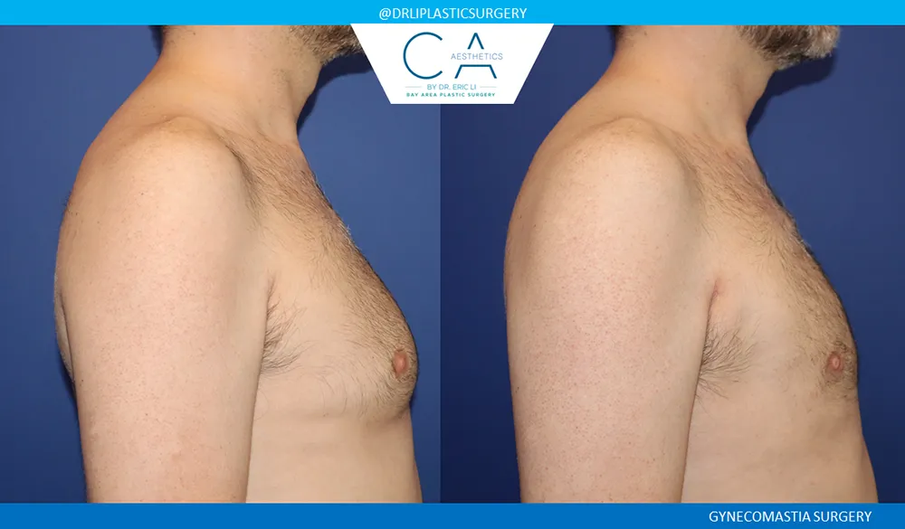 Gynecomastia case #9086