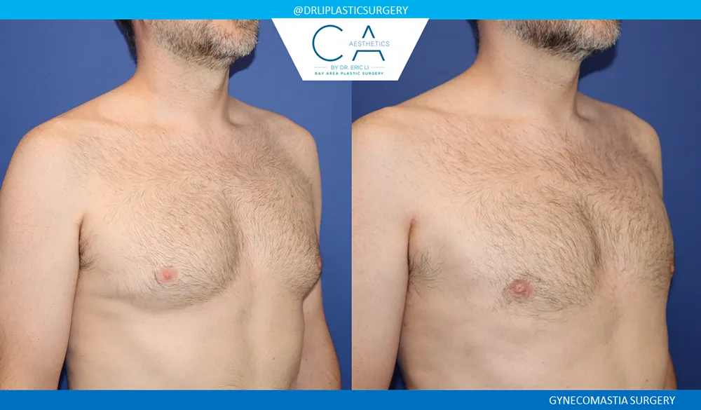 Gynecomastia case #9086
