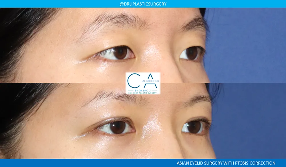 Asian Eyelid case #8974