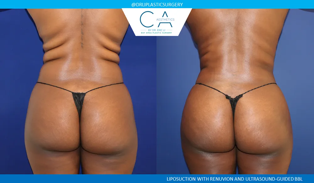 Brazilian Butt Lift case #8983