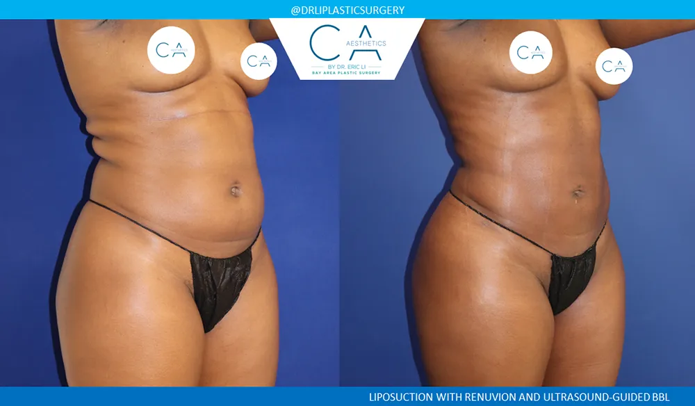 Brazilian Butt Lift case #8983