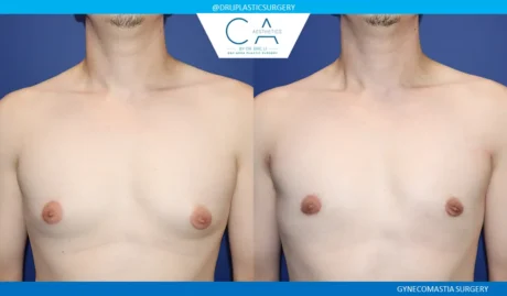 Gynecomastia case #9090