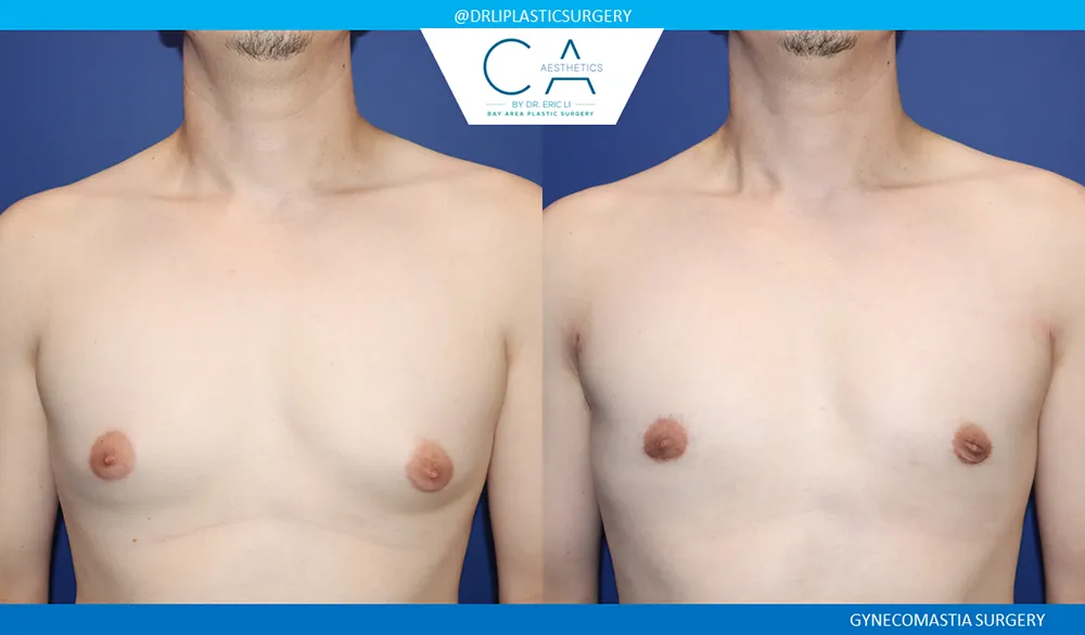 Gynecomastia case #9090