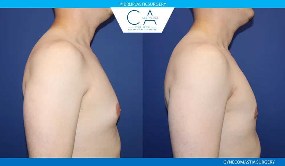 Gynecomastia case #9090