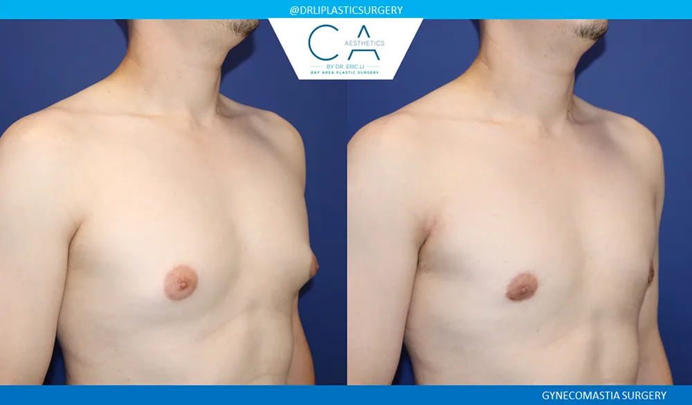 Gynecomastia case #9090