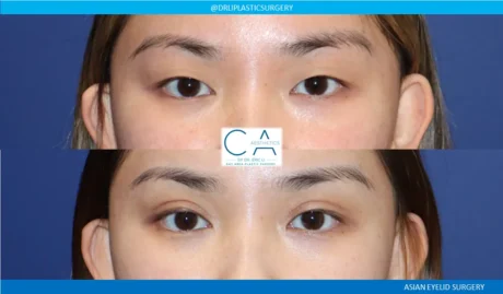 Asian Eyelid case #8977