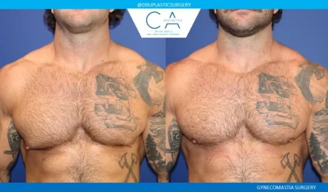 Gynecomastia case #9094