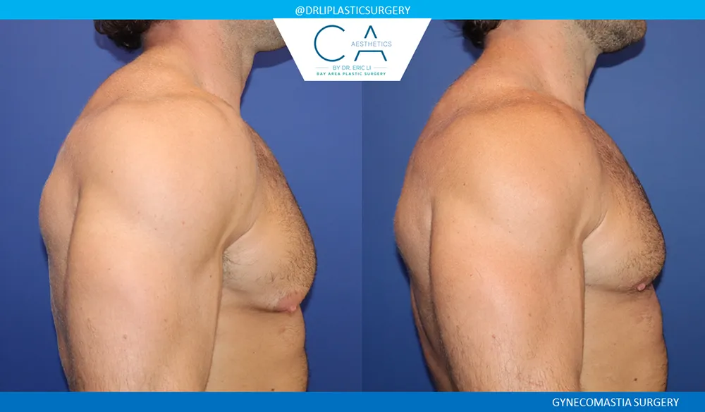 Gynecomastia case #9094