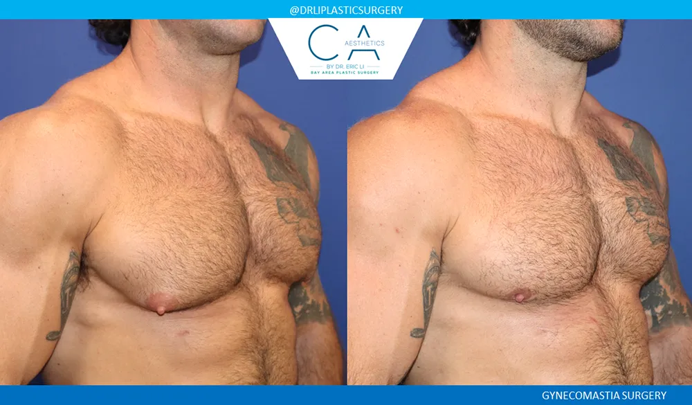 Gynecomastia case #9094