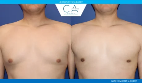 Gynecomastia case #9099